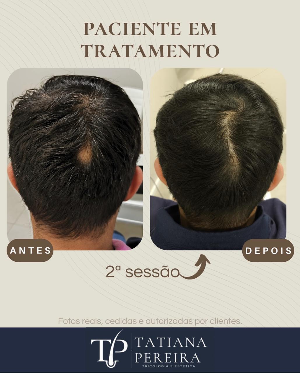 Resultado tratamento queda capilar masculina — paciente 2