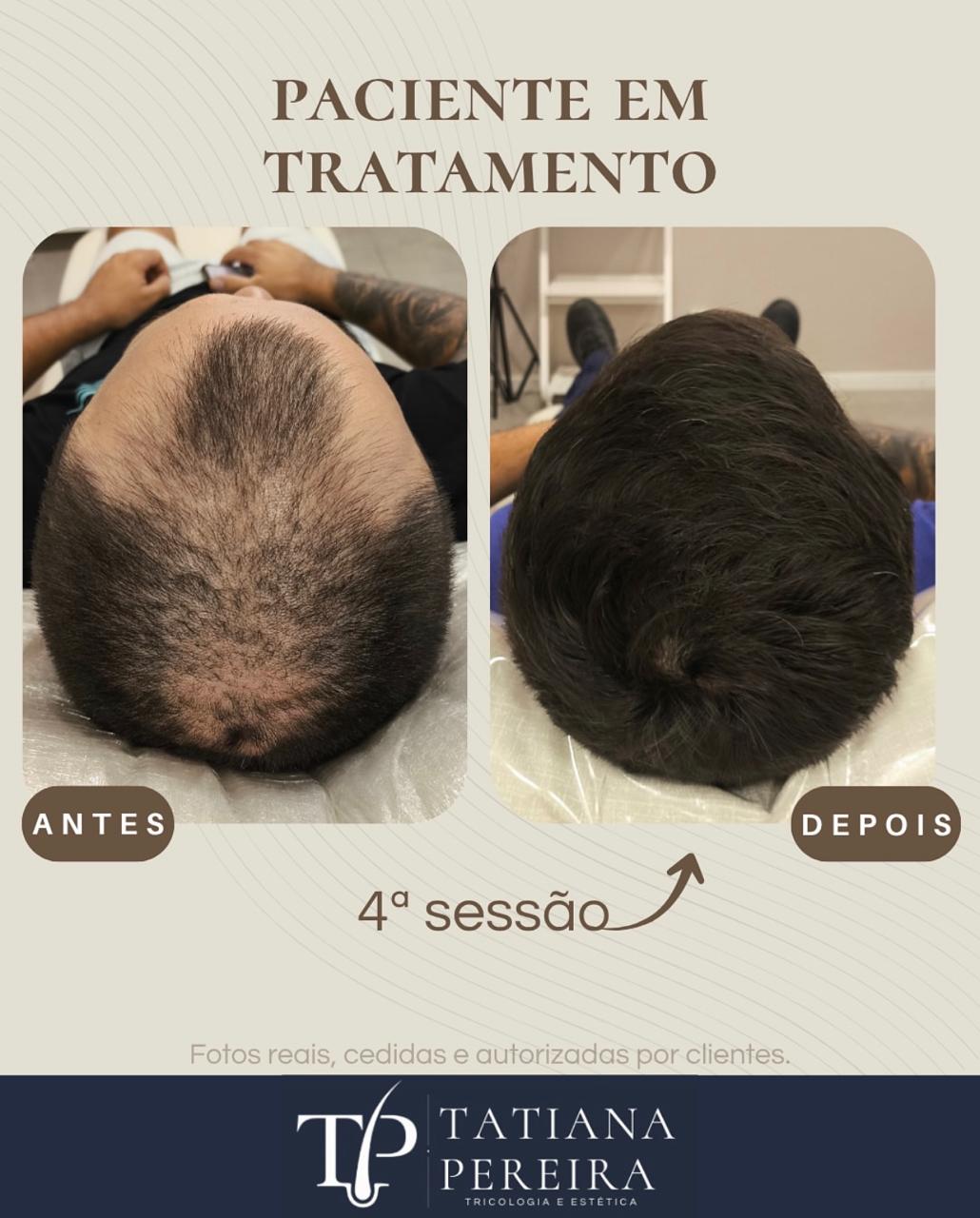 Resultado tratamento queda capilar masculina — paciente 4